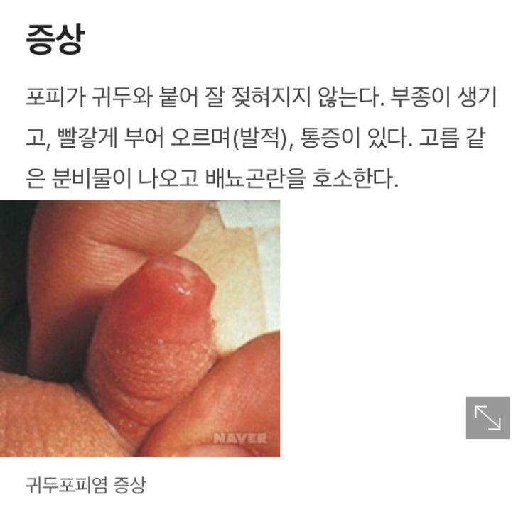  [육아] 유아 귀두표피염 아기 귀두표피염 초기 대응방법