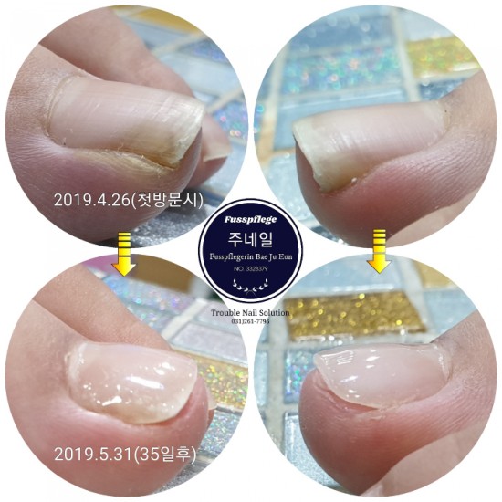 발톱이 파고들어 염증까지 생겼는데 참기만하는 아이들/분당용인수원수지보정동백죽전동/주네일/무좀파고드는발톱전문네일샵 발톱이 파고들어 염증까지 생겼는데 참기만하는 아이들/분당용인수원수지보정동백죽전동/주네일/무좀파고드는발톱전문네일샵