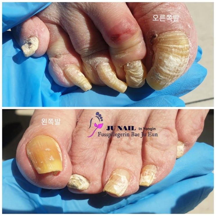 할머니의 뒤틀고 두꺼운 굽은발톱/분당용인수원수지보정동백죽전동/주네일/무좀파고드는발톱전문네일샵 할머니의 뒤틀고 두꺼운 굽은발톱/분당용인수원수지보정동백죽전동/주네일/무좀파고드는발톱전문네일샵