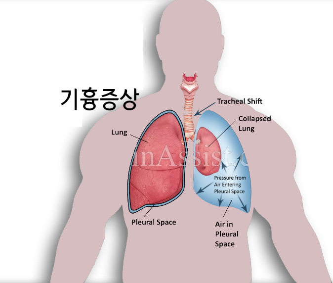  기흉증상 : 마르고 키 큰 사람이 흉통을 호소할때