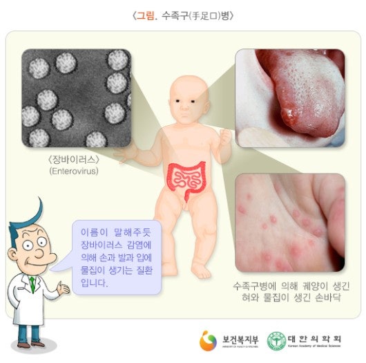 아기 수족구 증상, 물집, 연고, 음식