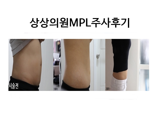MPL주사 2회차 후기(Feat.상상의원명동점 다이어트 복부지방분해주사
