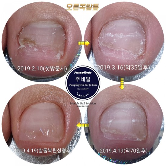 발톱무좀이라 보기 싫다고 다 뜯어오셨어요./분당용인수원수지보정동백죽전동/주네일/무좀파고드는발톱전문네일샵 발톱무좀이라 보기 싫다고 다 뜯어오셨어요./분당용인수원수지보정동백죽전동/주네일/무좀파고드는발톱전문네일샵
