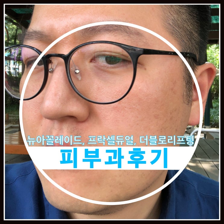 기미잡티제거 프락셀듀얼 뉴아꼴레이드 더블로리프팅후기