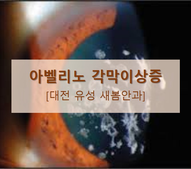  [대전 유성 새봄안과] 시력교정수술  전  선택이 아닌 필수! 아벨리노 각막이상증 검사에 대해 알아보자!