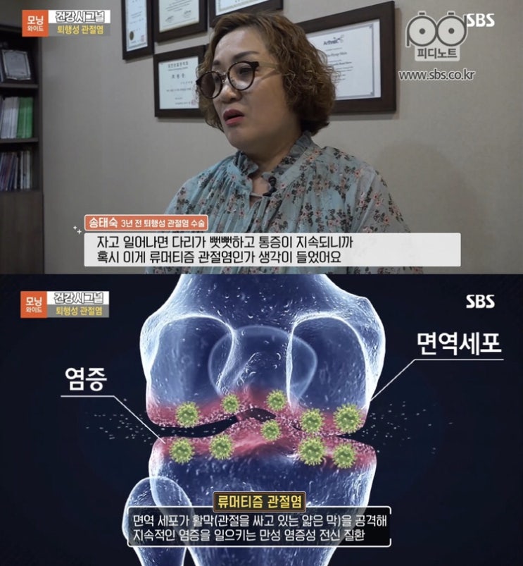  관절염에 좋은 더작 보스웰리아 효능 걱정없이 섭취하세요