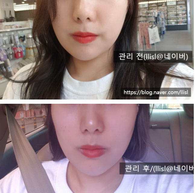  윤곽주사대신 DPL로 턱살 심부볼 조지기,천안피부관리 용곡동 브이라인