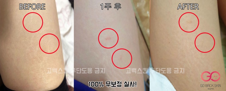  [고백스킨] 튼살커버 튼살문신 - 허벅지튼살 커버업 과정 및 후기사진