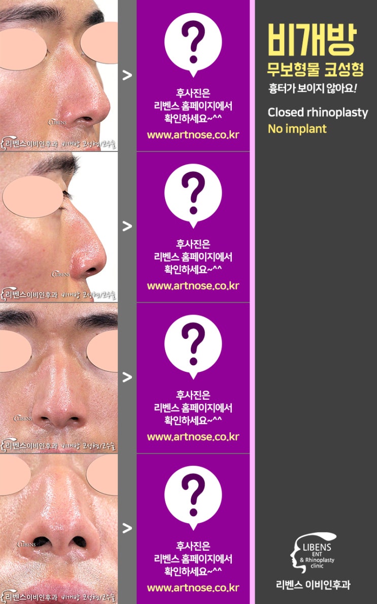 무보형 복비 성형 12
