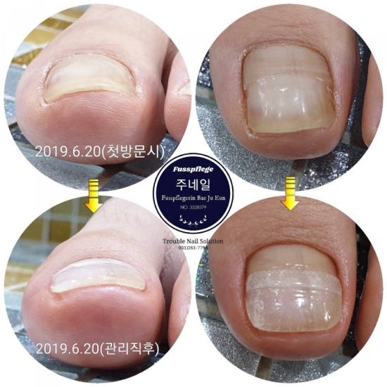 움직일때마다 아픈 내향성발톱 어떻게해야하나요/분당용인수원수지보정동백죽전동/주네일/무좀파고드는내향성발톱손톱변형전문네일샵 움직일때마다 아픈 내향성발톱 어떻게해야하나요/분당용인수원수지보정동백죽전동/주네일/무좀파고드는내향성발톱손톱변형전문네일샵