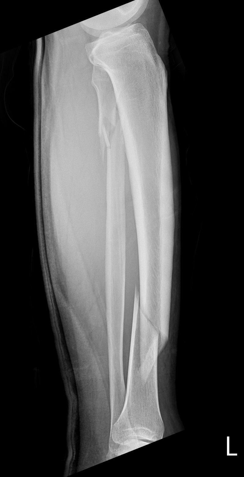 경비골 골절 Tibia & Fibula fracture / 경골 개방정복술 Tibia OR/IF ; Tibia Open ...