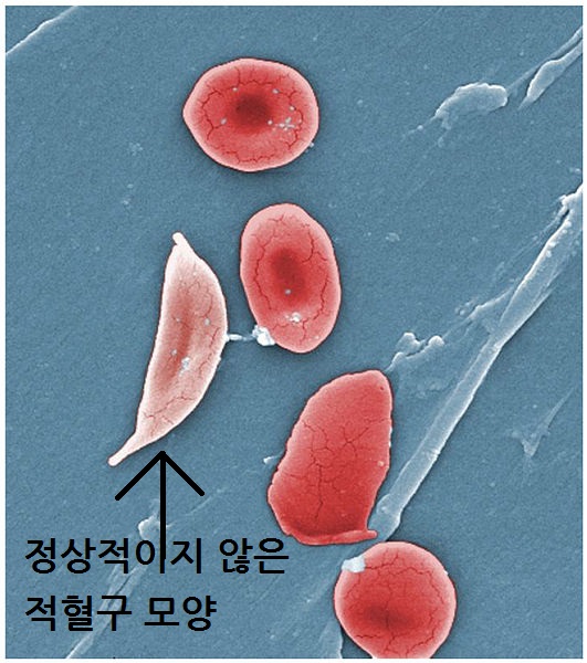  정상 빈혈수치 확인 및 자가진단하고 가세요