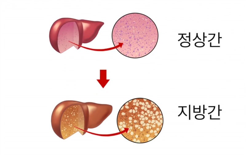 [간·담도·췌장센터] 간(Liver)과 담낭(gallbladder), 췌장(pancreas)의 이해 : 네이버 블로그