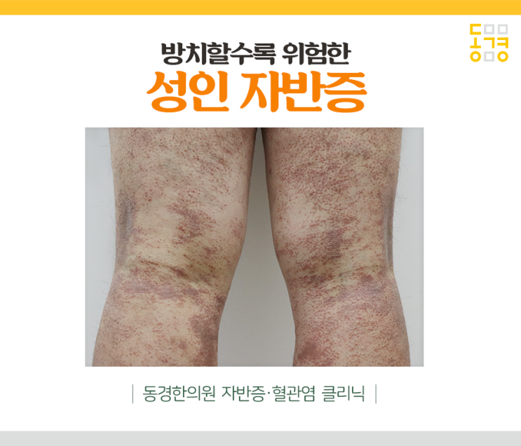  성인 자반증 증상 대수롭지 않게 넘기면 안 됩니다