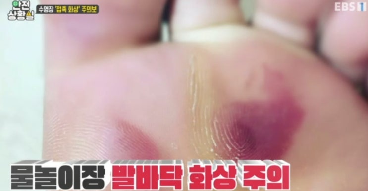  워터파크 수영장 발바닥 화상 주의보 아쿠아슈즈 필수?