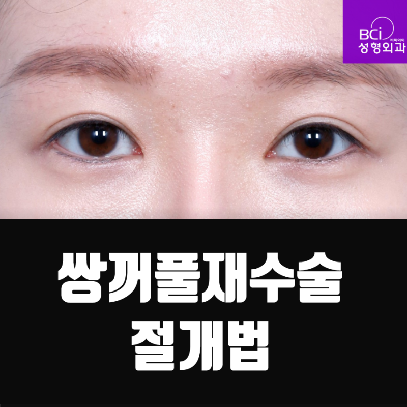 쌍꺼풀재수술 절개법도 이렇게 자연스러워? : 네이버 블로그