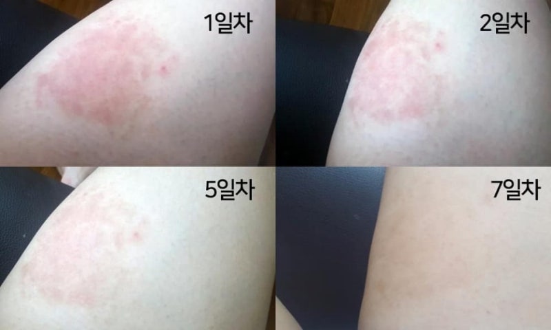 엉덩이 색소 침착, 엉겅퀴 없애는 방법은 어떻게? 6