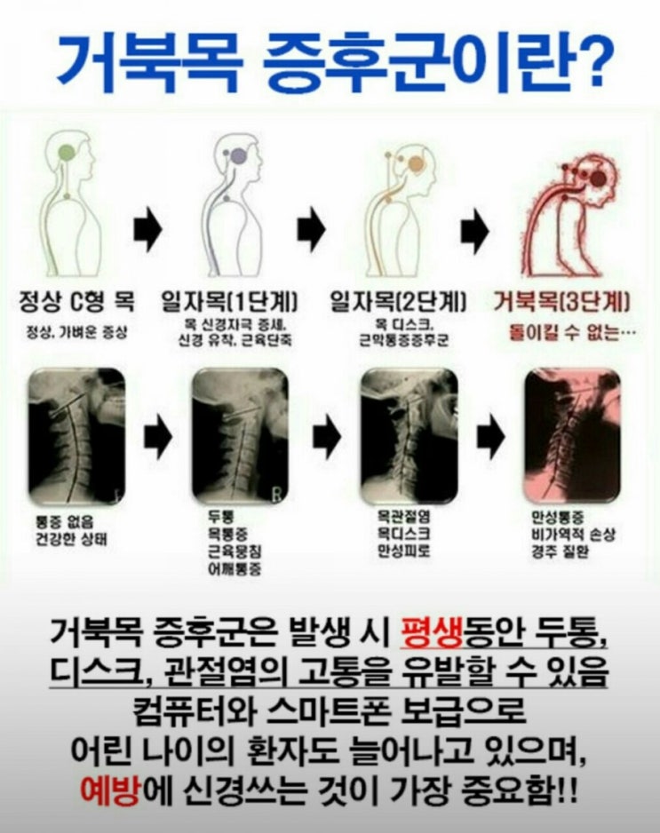 거북목 증후군