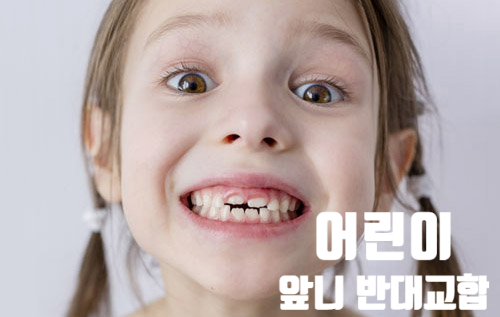 어린이 앞니 반대교합! 치료 어떻게 하나요? 어린이 앞니 반대교합! 치료 어떻게 하나요?