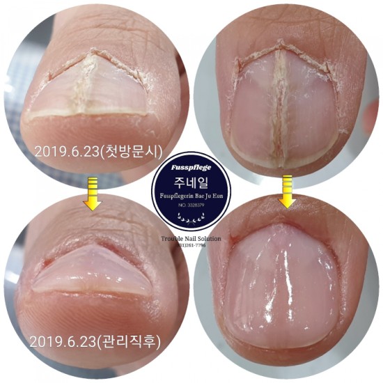 세로로 파여버린 빨래판손톱 변형이 심한 콤플렉스로 만들었어요./분당용인수원수지보정동백죽전동/주네일/무좀파고드는발톱전문네일샵 세로로 파여버린 빨래판손톱 변형이 심한 콤플렉스로 만들었어요./분당용인수원수지보정동백죽전동/주네일/무좀파고드는발톱전문네일샵