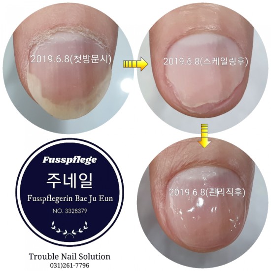 손톱 조갑박리증 2주후 경과모습/분당용인수원수지보정동백죽전동/주네일/무좀파고드는발톱전문네일샵 손톱 조갑박리증 2주후 경과모습/분당용인수원수지보정동백죽전동/주네일/무좀파고드는발톱전문네일샵
