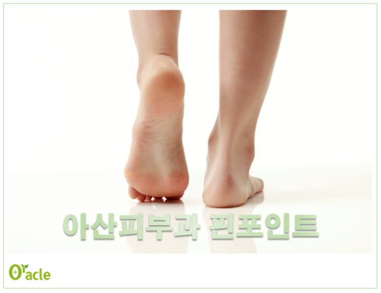  아산피부과, 손발톱 무좀 치료 "핀포인트"