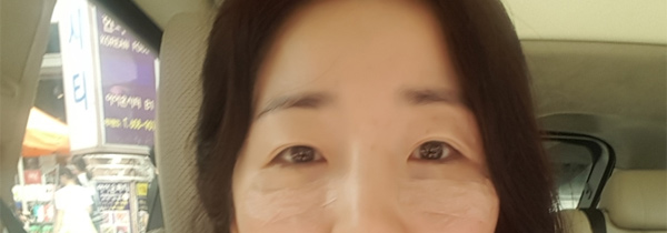  눈밑지방제거 하고 오다