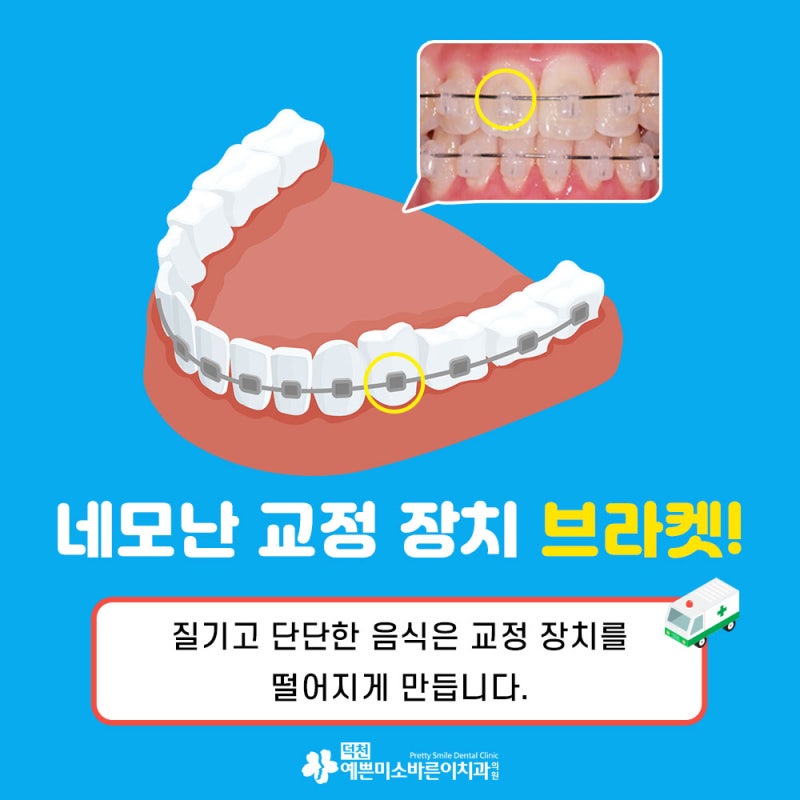 교정기가 떨어졌을 때 대처 방법은? : 네이버 블로그