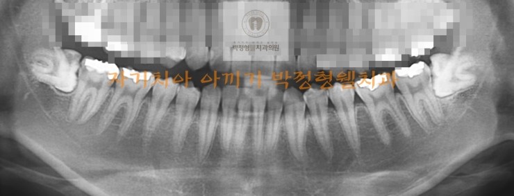  부산 잘 하는 치과  수영 좋은 치과 <박정형웰치과> 매복 사랑니 발치 증례입니다.