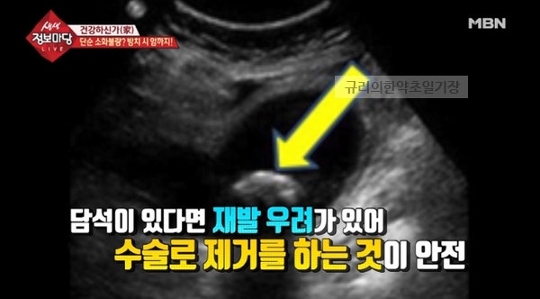담석증 진단을 알고 있다면?