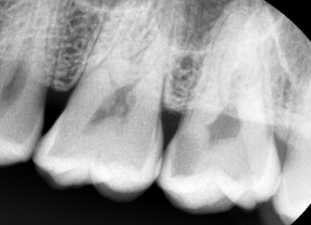 치과의사가 받은 치아치료 & x-ray와 검진의 중요성