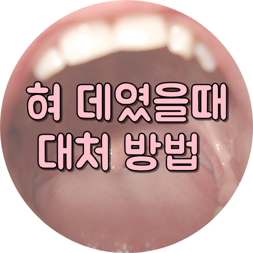  혀 데였을때 , 혓바닥 데임 어떻게 해야 하나요?