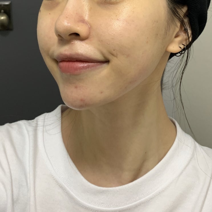  대구 피부관리실 제이스킨 "블랙헤드/피지관리" 받고 왔어욥!(૭ ᐕ)૭ (피지사진 주의)