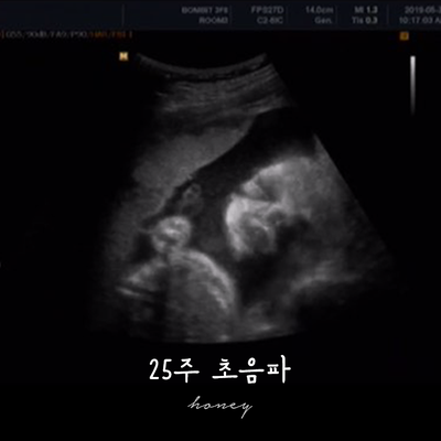  임신일기 25주 : 임당검사, 초음파, 임산부 공황장애, 미주신경장애