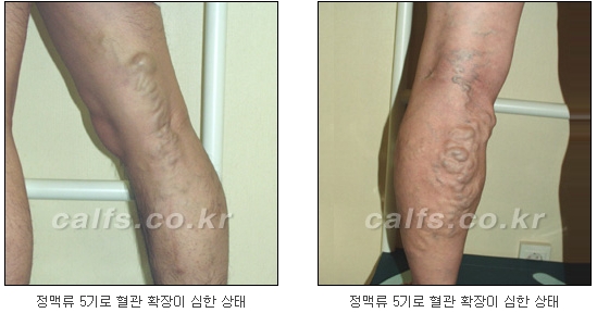  [두한성형외과 종아리성형] - [정맥류문제점, 원인, 진단방법]