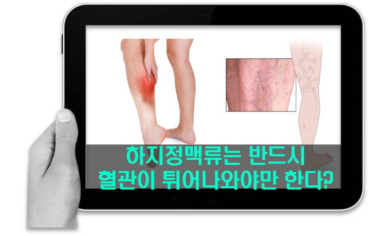  종아리통증 혈관돌출 없어도 하지정맥 검사 필요한 까닭