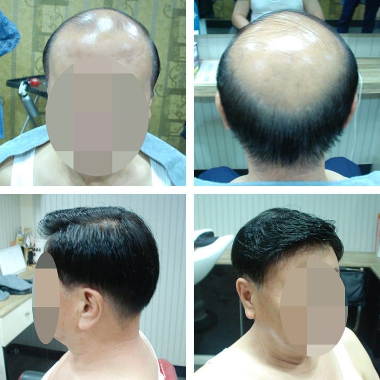  [모위드] 부산 중년 원형탈모 커버 가발