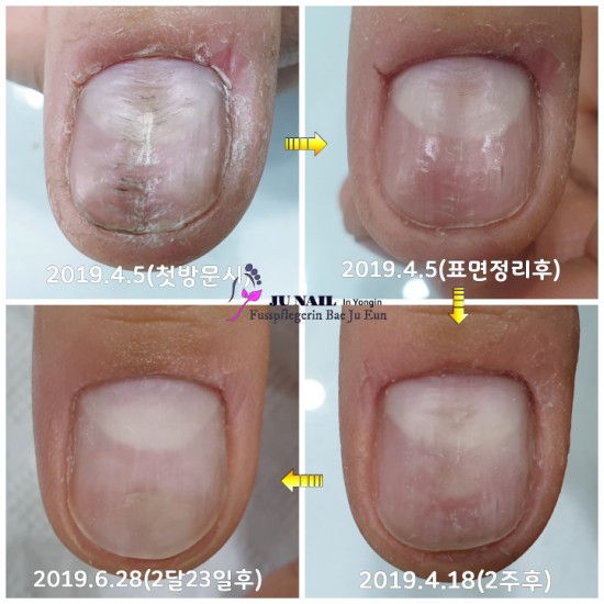 울퉁불퉁 손톱변형 이제는 당당해졌어요(빨래판손톱/워시보드네일) /분당용인수원수지보정동백죽전동/주네일/무좀파고드는내향성발톱전문네일샵 울퉁불퉁 손톱변형 이제는 당당해졌어요(빨래판손톱/워시보드네일) /분당용인수원수지보정동백죽전동/주네일/무좀파고드는내향성발톱전문네일샵