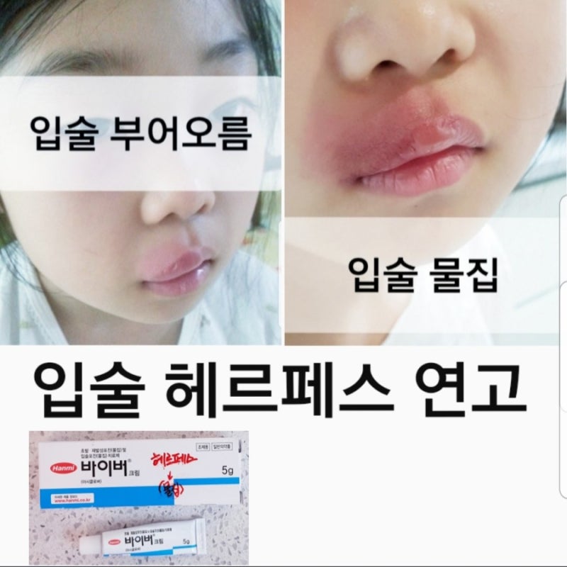 초발 재발 입술물집(코밑 포진) 아시클로버 연고, 바이버크림 치료, 단순 헤르페스 입술포진 원인과 치료법, 부어오름 증상 수포, 코밑 헐었을때 상처 딱지 흉터자국은 오래 가네요! : 네이버 블로그 초발 재발 입술물집(코밑 포진) 아시클로버 연고, 바이버크림 치료, 단순 헤르페스 입술포진 원인과 치료법, 부어오름 증상 수포, 코밑 헐었을때 상처 딱지 흉터자국은 오래 가네요! : 네이버 블로그