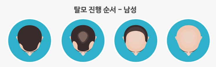 머리만 만져도 알 수 있는 연모화를 알아보고 탈모 자가진단하기! 머리만 만져도 알 수 있는 연모화를 알아보고 탈모 자가진단하기!