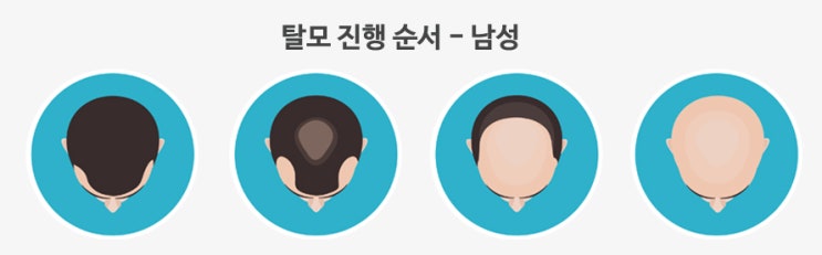 머리만 만져도 알 수 있는 연모화를 알아보고 탈모 자가진단하기!