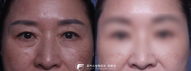  [부천성형외과 Dr. 김  칼럼] 내시경이마거상술