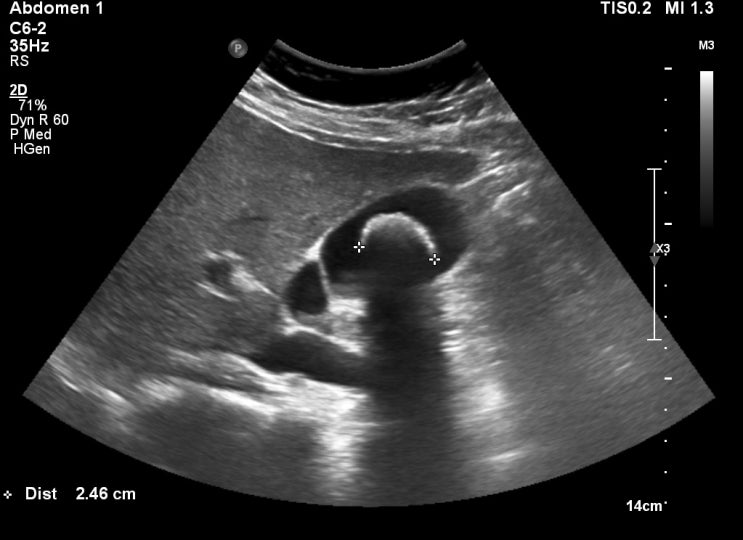  담석증(gallstone)에 대해.