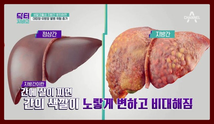  지방간에 좋은 음식 알아보기