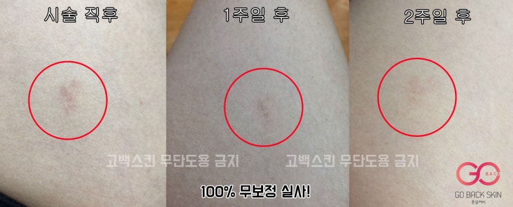  [고백스킨] 흉터커버 튼살타투 - 테스트 튼살 커버 과정 및 소개