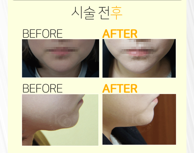 광주턱보톡스 무턱라인과 사각턱까지 문제없는 잘하는곳 4