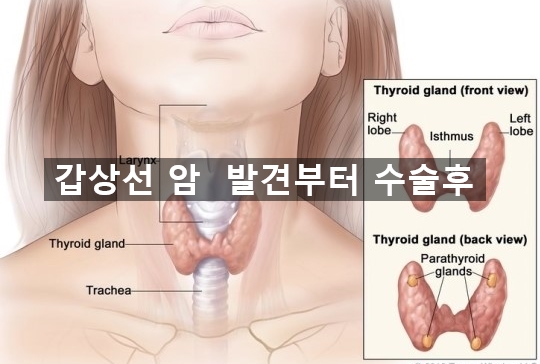  건강검진으로 갑상선암 발견 부터 수술이후 관리까지 - 1
