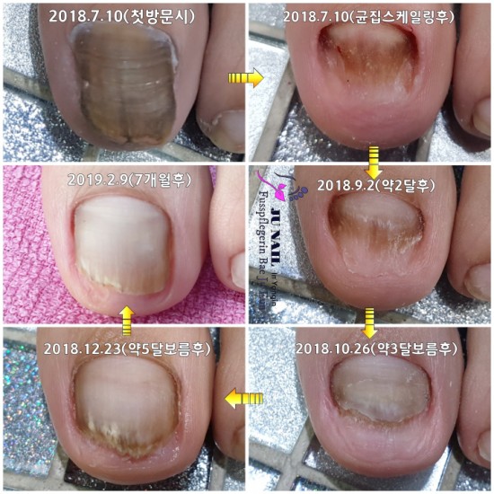 무좀관리 7개월경과후기/분당용인수원수지보정동백죽전동/주네일/무좀파고드는내향성발톱전문네일샵