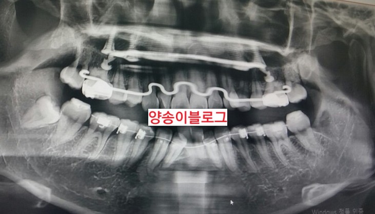  d+130 교정일기마지막 매복 사랑니 발치+철사바꾸기