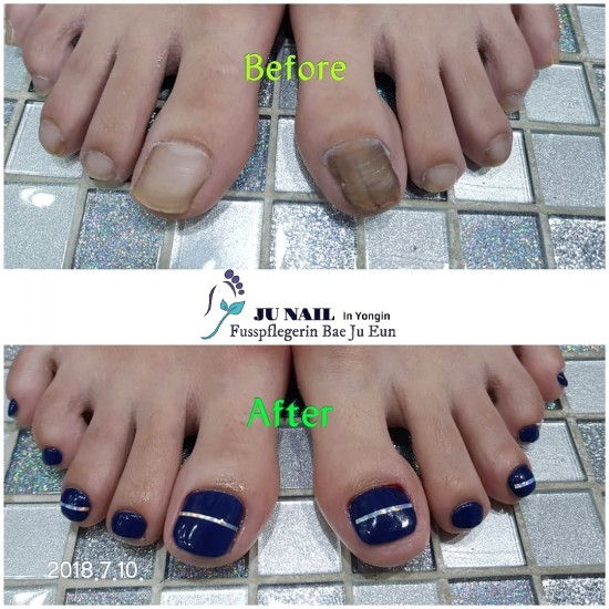 무좀관리3개월후/분당용인수원수지보정동백죽전동/주네일/파고드는내향성발톱 무좀관리3개월후/분당용인수원수지보정동백죽전동/주네일/파고드는내향성발톱